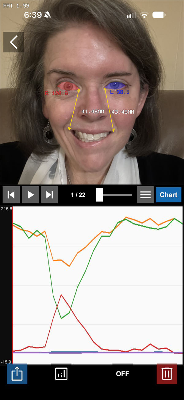 Dynaface on iPhone analyzing a video: facial landmarks are drawn on the current frame, and a chart below tracks the selected measurements across every frame.